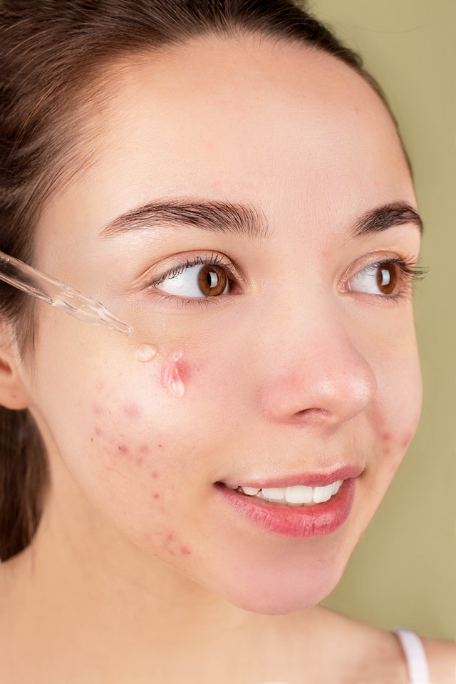 Acne Scar Removal in Singapore: 7 Ways to Treat Acne Scars