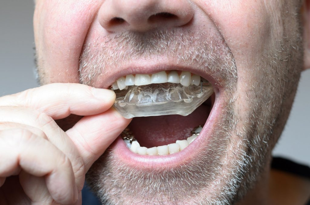 Custom Mouthguard
