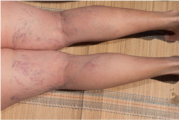 Laser Vein Treatment: Safe, Effective, and almost Painless