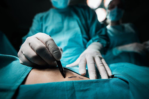 Understanding Liposuction: Procedure, Preparation, and Recovery 