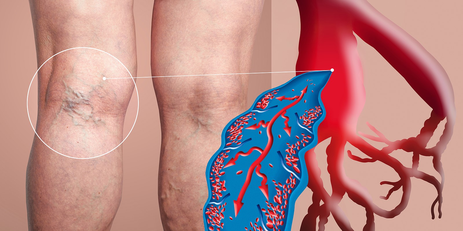 What Are The Major Symptoms Of Blood Clot In Leg