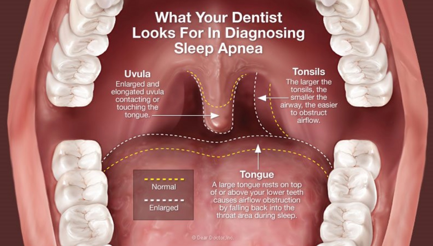 How Do I Know If I Have Sleep Apnea